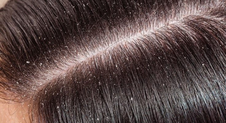 how to cure dandruff permanently