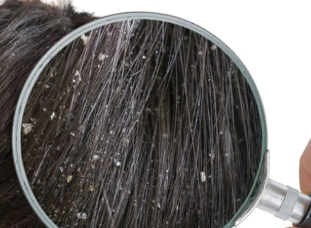 how-to-cure-dandruff-fast